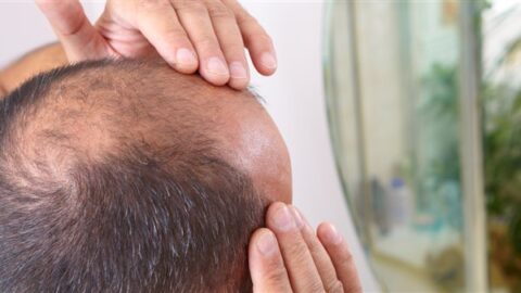 باحثون إسبان يطورون علاجا واعدا للصلع