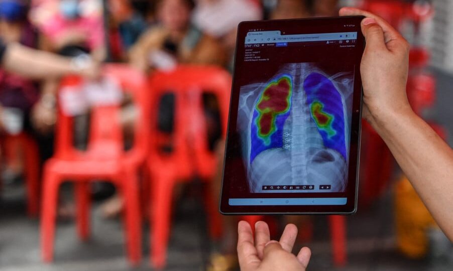 أدوية المناعة الذاتية قد تعيد تنشيط السل الكامن بجسم الإنسان