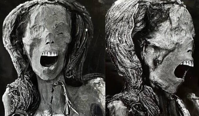 علماء يكتشفون خضوع امرأة لجراحة متقدمة في الفك السفلي قبل 2500 عام