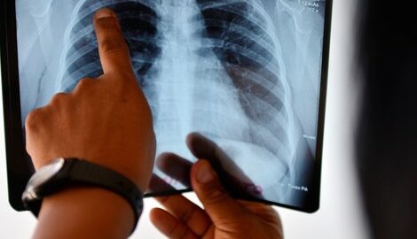 حوالي 34% من حالات الإصابة بالسل في ناميبيا غير مشخصة